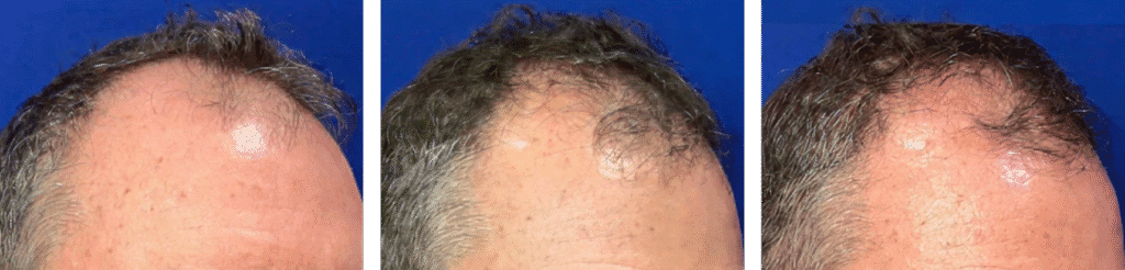 Hair regrowth results - Baseline, After 6 months, After 7 months