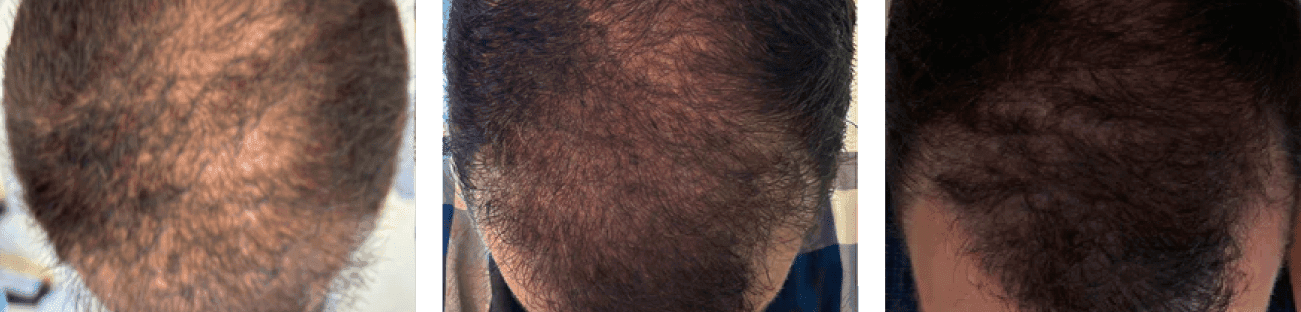 Hair regrowth results - Baseline, Day 60, Day 90