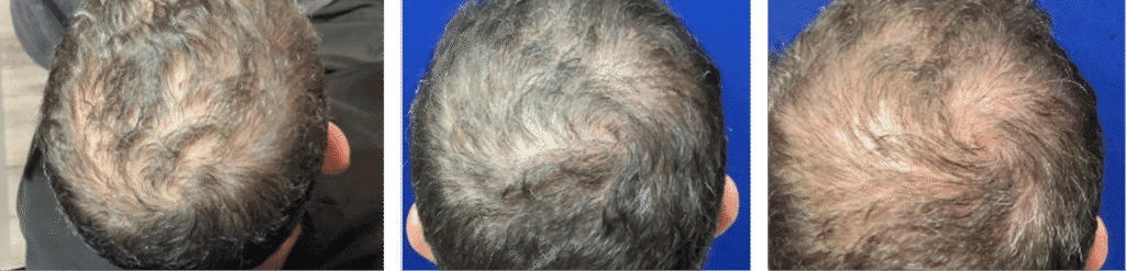 Hair regrowth results - Baseline, After 6 months, After 7 months