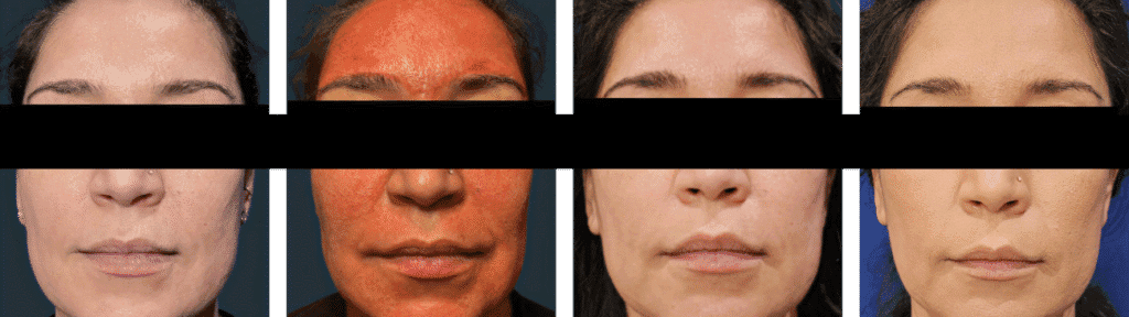 Skin recovery timeline - Baseline, Immediately After, Day 1, Day 4