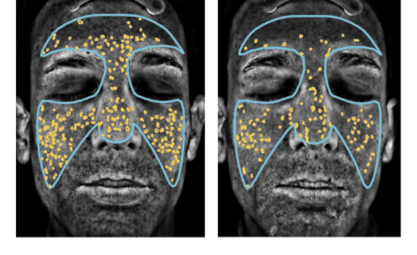 Visible improvement in pores - Baseline vs Day 68