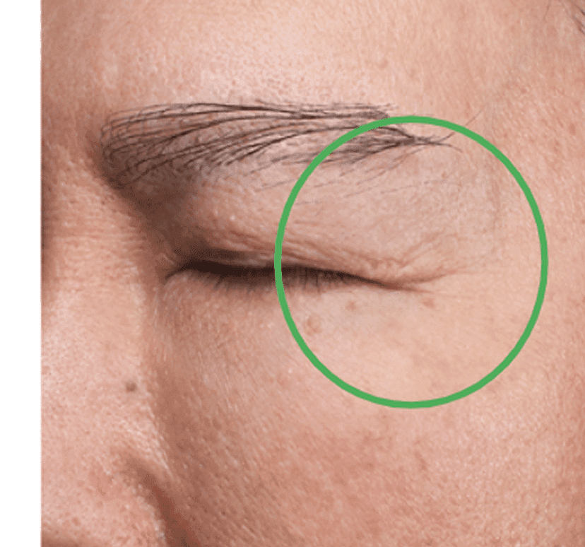 Wrinkle improvement - Baseline