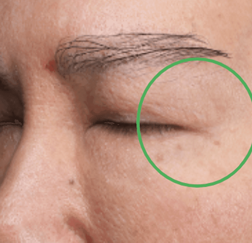 Wrinkle improvement - Day 60