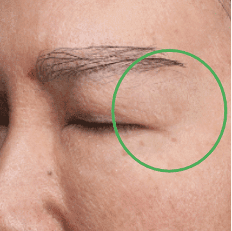 Wrinkle improvement - Day 90